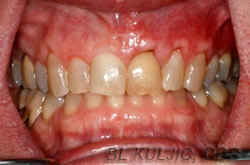 Gum recession second case after