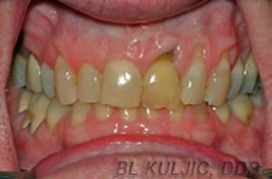 Gum recession second case before