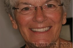 An implant-supported denture restoring chewing and speech