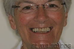 Failing teeth before implant-supported denture treatment