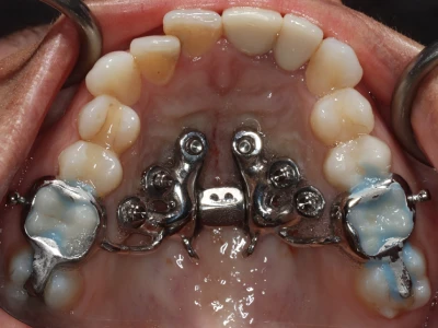 Upper jaw at the start of treatment, with the MARPE expander just placed