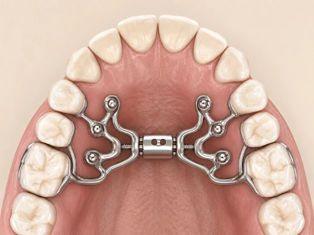 MARPE skeletal expander anchored to the upper palate with miniscrews