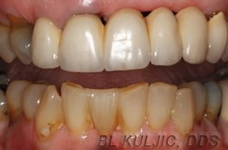 Missing lower front tooth restored with a Maryland bridge