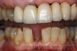 Lower front tooth missing before treatment