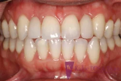 Dental bridges case after