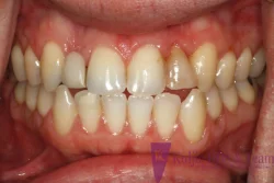 Dental bridges