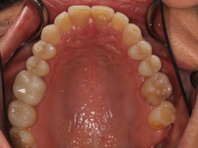Upper dental arch before MSE expansion in an adult, showing a wider palate