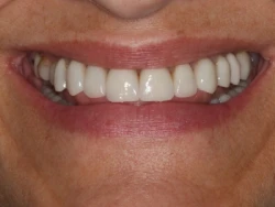 Adult patient's smile after MSE expansion, myofunctional therapy, and porcelain veneers, showing a wider arch and uniform white teeth