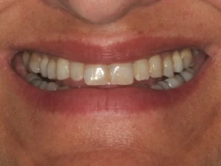 Adult patient's smile before treatment, with a narrow arch, worn and discolored teeth