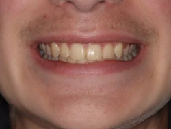 Broader, fuller smile of the same teenage patient after MSE palatal expansion, with the upper arch widened and teeth aligned