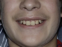 Narrow smile of a 15-year-old before MSE palatal expansion, with a constricted upper arch and dark corners at the sides of the smile