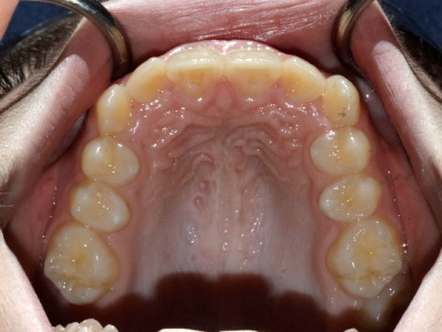 Upper dental arch before MSE expansion, showing a wider palate