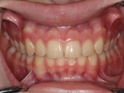 Close-up of teeth alignment after MSE expansion