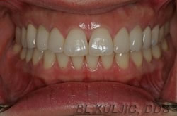 Aligned teeth restored with two implants and whitening