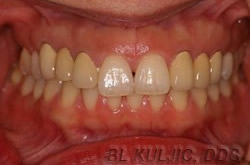 Misaligned teeth with an old mismatched bridge before treatment