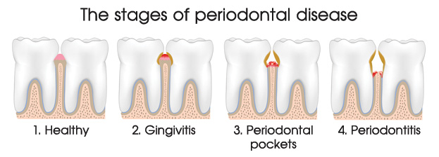Periodontal - Gum disease stages