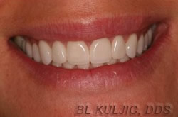 After complete smile rehabilitation with porcelain veneers