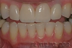 Front teeth after porcelain veneers and crown, even and uniform