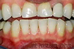 Front teeth before porcelain veneers and crown