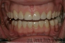 Rebuilt teeth after porcelain veneers and ceramic crowns