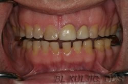 Teeth eroded by acid reflux before porcelain veneers