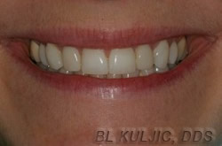 Brighter, even smile after porcelain veneers and implant crowns