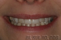 Smile before porcelain veneers and implant crowns