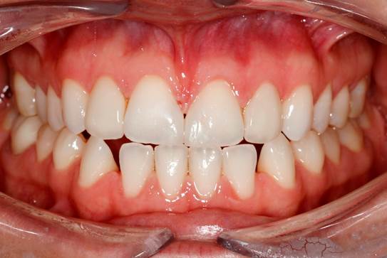 Front teeth gap closed after porcelain veneers, close-up