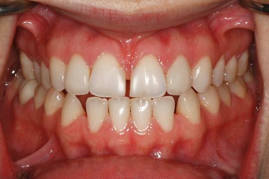 Front teeth gap before porcelain veneers, close-up