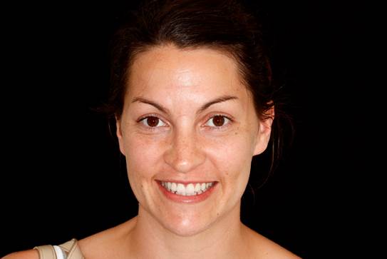 Patient after porcelain veneers close a front tooth gap