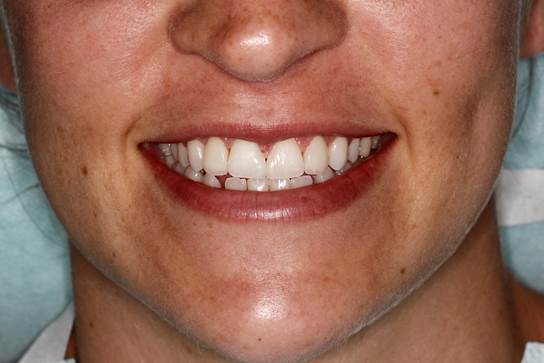 Smile after porcelain veneers close the front tooth gap