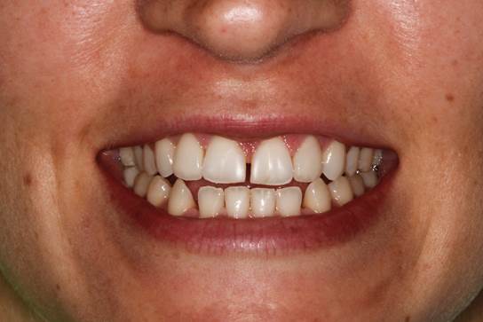 Smile with front tooth gap before porcelain veneers