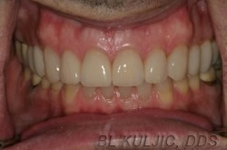 Lower front teeth after porcelain veneers close the gaps