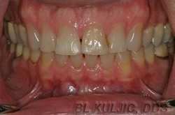 Lower front teeth with gaps before porcelain veneers