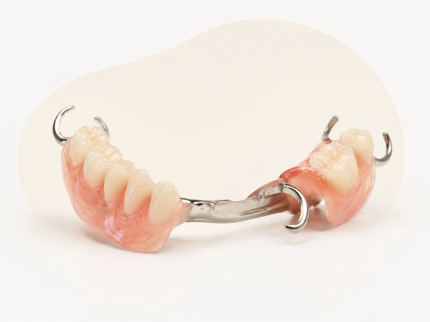 Removable partial denture with replacement teeth and metal clasps