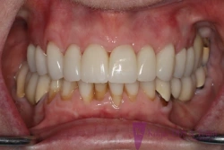 After restorative dentistry with feldspathic porcelain veneers