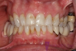 Before restorative dentistry with feldspathic porcelain veneers