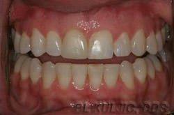 After short-term adult orthodontics
