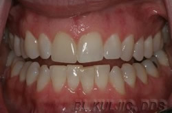 Before short-term adult orthodontics