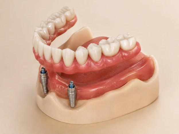 A removable denture positioned above two dental implants in the lower jaw