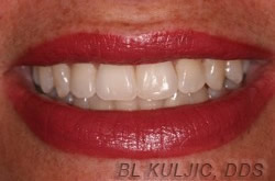 Straightened, brighter smile after adult braces and whitening