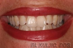 Crooked teeth before adult straight wire braces