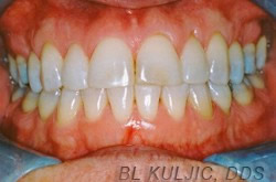 Brighter teeth after professional custom-tray whitening