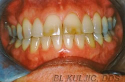 Teeth before professional custom-tray whitening