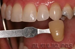 Evenly matched tooth after internal whitening