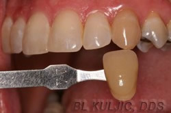 Single darkened tooth before internal whitening