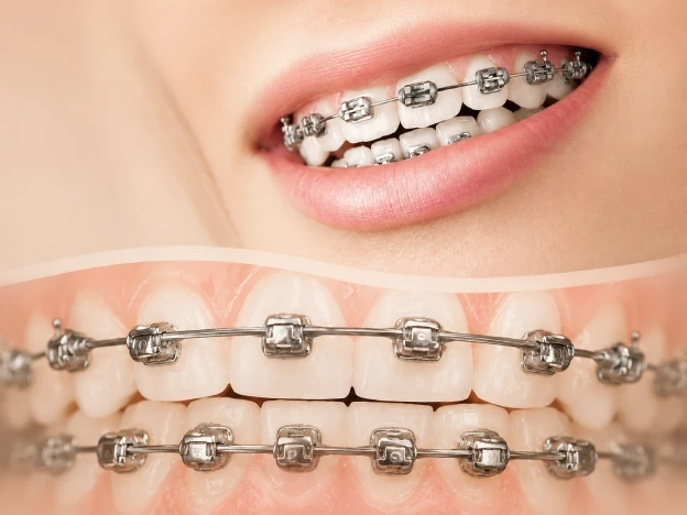 Traditional metal braces shown in close-up on upper and lower teeth