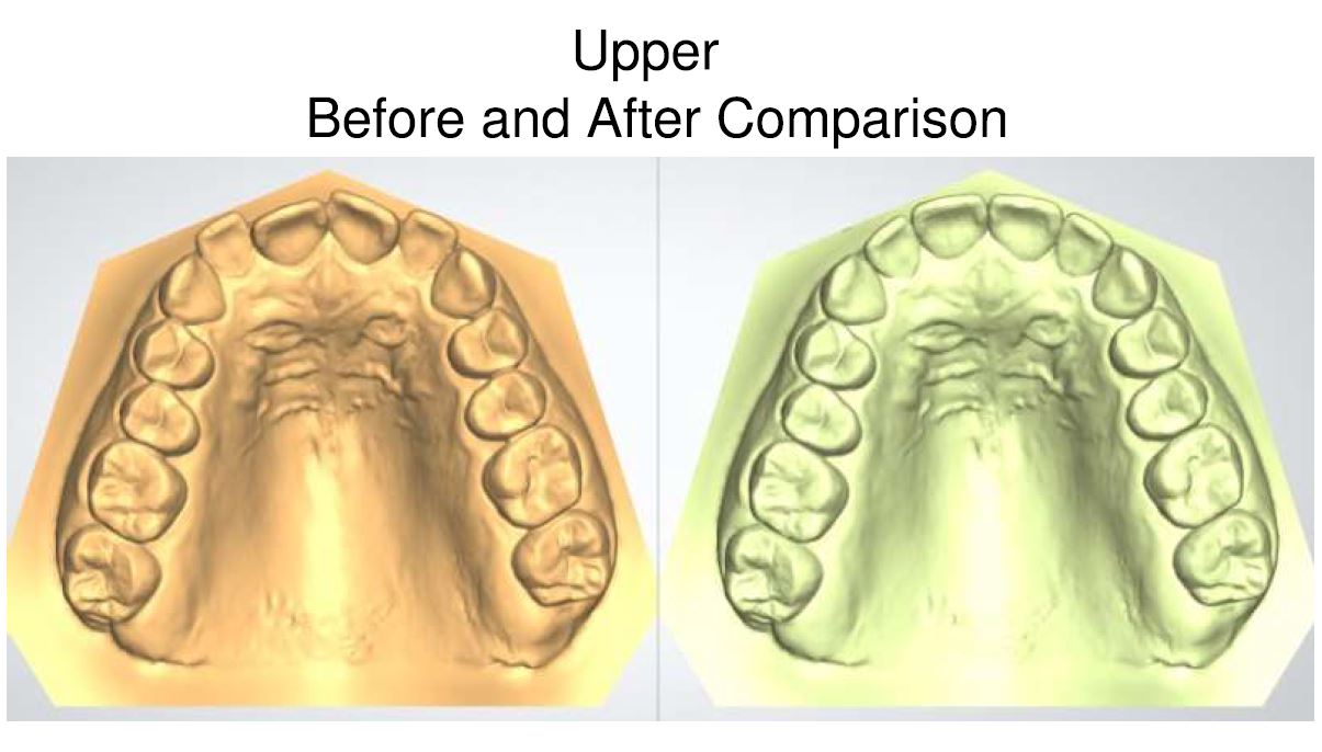 3D scan comparison of upper teeth before and after clear aligner treatment