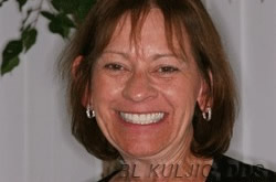 A full upper denture restoring the smile