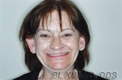 Failing upper teeth before denture treatment